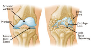 knee oa cartoon